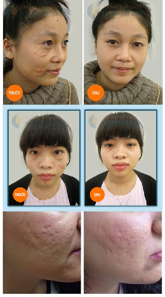 laser fractional co2 truoc va sau khi lam.jpg (312 KB)